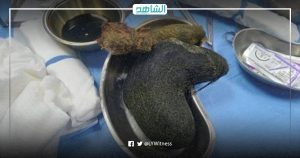 عملية نادرة.. طاقم طبي ليبي يستخرج كتلة شعر ضخمة من باطن فتاة